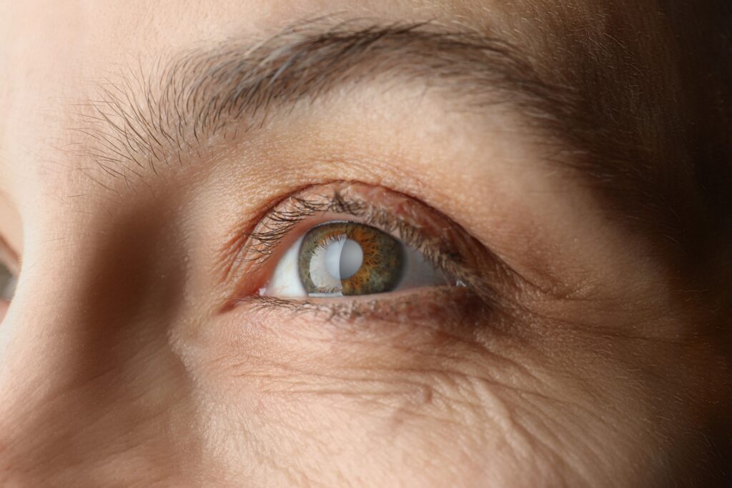 The Complete Guide to Cataracts Surgery: From Diagnosis to Recovery